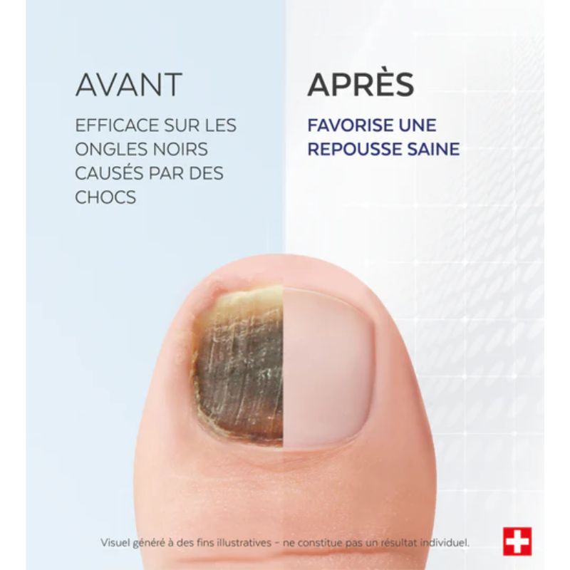 Sérum Ongles noirs, traumatisés 8ml | Ongle du sportif